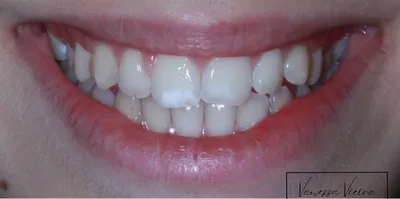 Antes: manchas brancas nos dois dentes da frente, de cima
