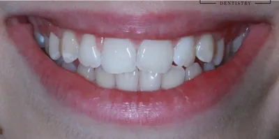 Depois: os dois dentes da frente com a cor uniforme
