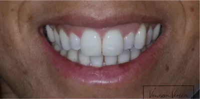 Antes: os dentes ao lado dos da frente, pequenos e estreitos