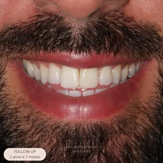 Sorriso de um homem de barba, 2 anos e 7 meses depois de um branqueamento e de duas restaurações