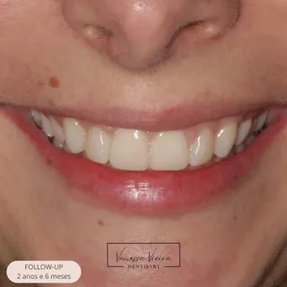 Sorriso de uma paciente com bruxismo, 2 anos e 6 meses depois de seis restaurações em resina