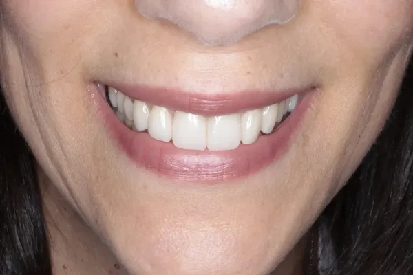 Sorriso natural de uma paciente. Alguns destes dentes foram tratados com resina